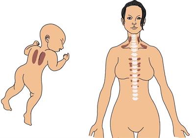 Brown Adipose Tissue and Novel Management Strategies for Polycystic Ovary Syndrome Therapy